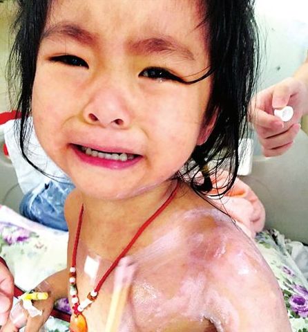 3歲的蘭蘭，全身紅疹，因疼癢難忍而大哭
