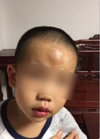 男童被送快遞的電動(dòng)車撞飛一米多，額頭腫起乒乓球大的包